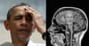 Cause of Barack Obama’s constant headache discovered during MRI scan