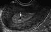 Blurry Dot On Ultrasound Already Receiving More Love From Christians Than A Caged Tamil Child
