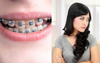 Local Woman Who Had To Suffer Through Hideous Steel Braces Stares Daggers At Little Sister’s Clear Teeth Aligners
