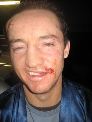 Hard done by ... Jason Taylor's face after he was assaulted by his own player while coaching South Sydney in the early 2000s